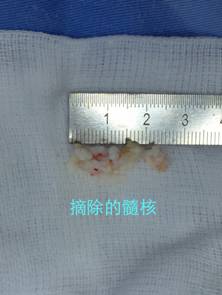 局麻下也能做椎间盘手术，次日即可下床行走
